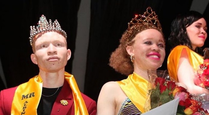 Mr. & Miss. Albinism Kenya, Jairus Ongeta (K.U) & Loice Lihenda. #BeautyBeyondtheSkin